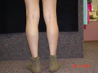 Calf Implants 692868