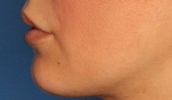 25-34 year old woman treated with Lip Augmentation before 3711751