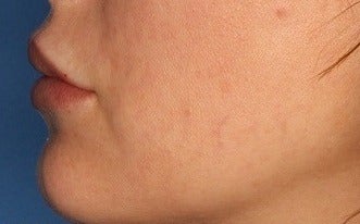 25-34 year old woman treated with Lip Augmentation after 3711751
