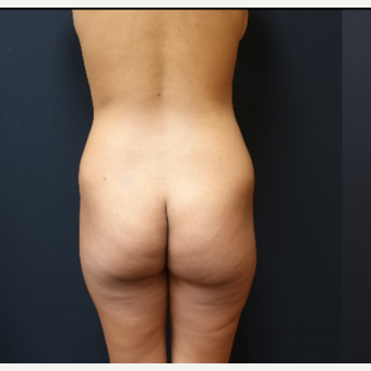 25-34 year old woman treated with Butt Lift before 3731802