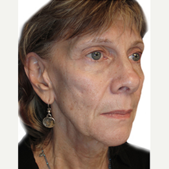 55-64 year old woman treated with Neck Lift before 3408988