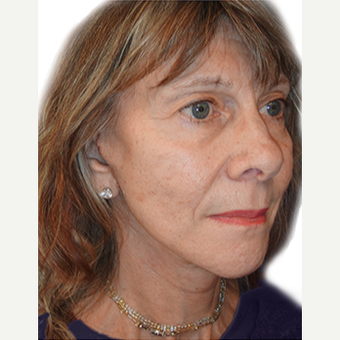 55-64 year old woman treated with Neck Lift after 3408988