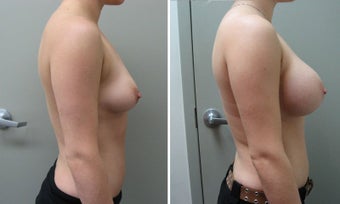 Breast Augmentation 450cc before 1271619