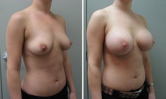 Breast Augmentation 450cc after 1271619