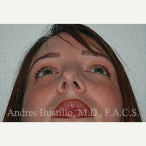 36 year old woman treated with Revision Rhinoplasty before 3460752