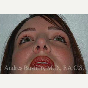 36 year old woman treated with Revision Rhinoplasty after 3460752