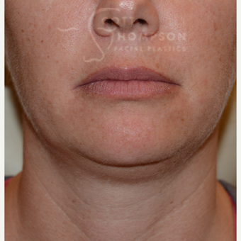 35-44 year old woman treated with Chin Liposuction before 3811303