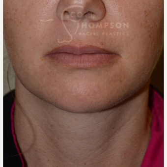35-44 year old woman treated with Chin Liposuction after 3811303