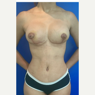 35-44 year old woman treated with Breast Lift with Implants after 3134746