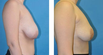 23 Year Old Woman, Breast Asymmetry and Tuberous Breast Correction with Fat Transfer 1039948