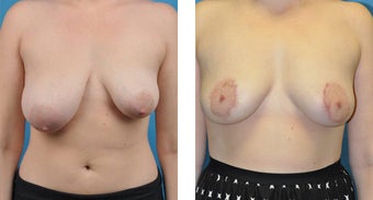 23 Year Old Woman, Breast Asymmetry and Tuberous Breast Correction with Fat Transfer before 1039948