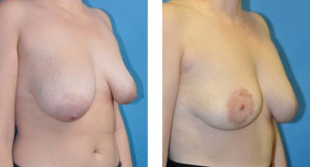 23 Year Old Woman, Breast Asymmetry and Tuberous Breast Correction with Fat Transfer after 1039948