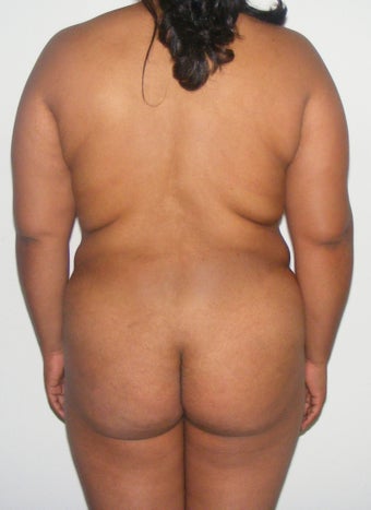 24 years old female treated for lipodistrofy on her back ( fat exces on her back) before 983118