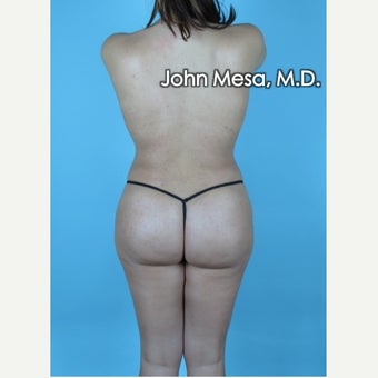 25 year old female after Brazillian Butt Lift after 1719837