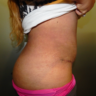 25-34 year old woman treated with Tummy Tuck after 3445974