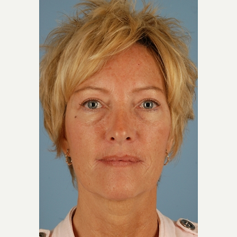55 year old woman treated with Eyelid Surgery after 3839971