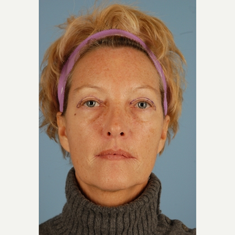 55 year old woman treated with Eyelid Surgery before 3839971