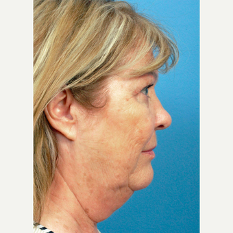 65-74 year old woman treated with Facelift before 3454218