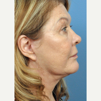 65-74 year old woman treated with Facelift after 3454218