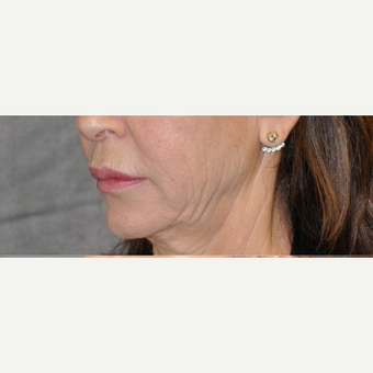45-54 year old woman treated with Lip Lift before 3004957