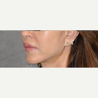 45-54 year old woman treated with Lip Lift after 3004957