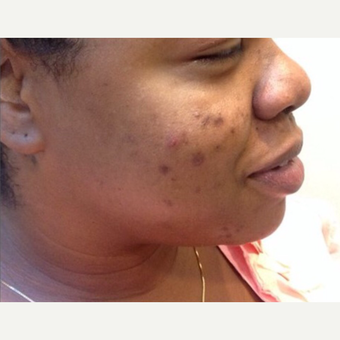 25-34 year old woman treated with Chemical Peel before 3443908