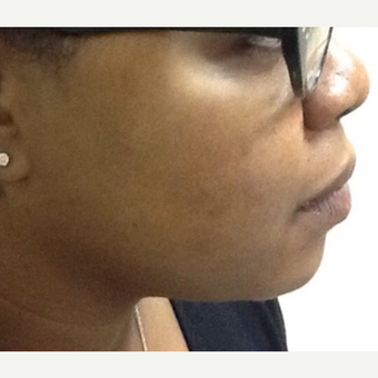 25-34 year old woman treated with Chemical Peel after 3443908