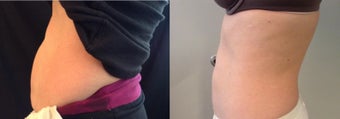 39 Year Old female treated for stubborn abdominal fat after 1405849