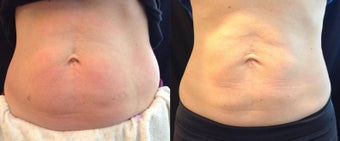 39 Year Old female treated for stubborn abdominal fat before 1405849
