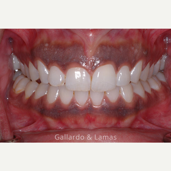 25-34 year old woman treated with Gum Lift before 3075248