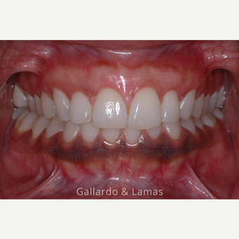 25-34 year old woman treated with Gum Lift after 3075248
