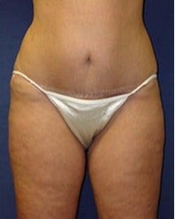 45-54 year old woman treated with Mini Tummy Tuck after 2058490
