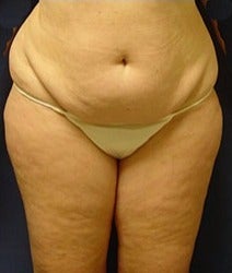 45-54 year old woman treated with Mini Tummy Tuck before 2058490