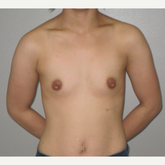 25-34 year old woman treated with Breast Augmentation before 3666717
