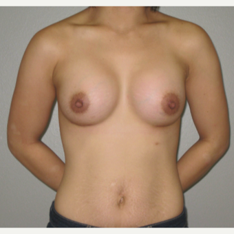 25-34 year old woman treated with Breast Augmentation after 3666717