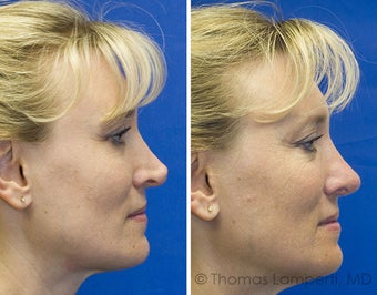 Revision rhinoplasty after 233188