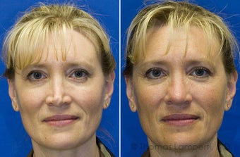 Revision rhinoplasty before 233188