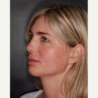 35-44 year old woman treated with CO2 Laser before 2454508