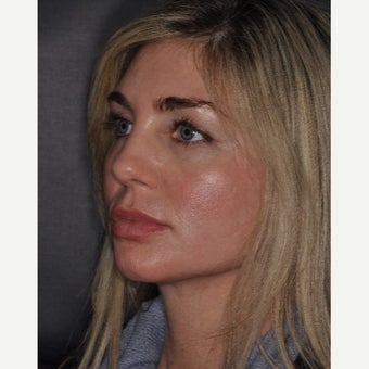 35-44 year old woman treated with CO2 Laser after 2454508