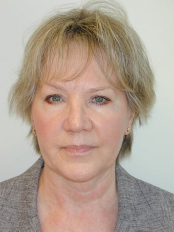 Wrinkle Treatment with the Eterna Face program (combination of peels, lasers, skincare and injections). after 1198897