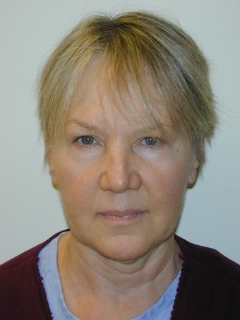 Wrinkle Treatment with the Eterna Face program (combination of peels, lasers, skincare and injections). before 1198897