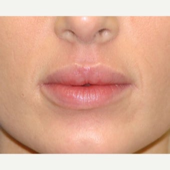 25-34 year old woman treated with Fat Transfer after 2502722