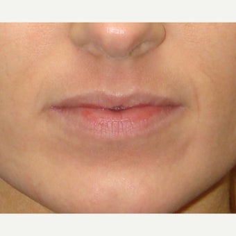 25-34 year old woman treated with Fat Transfer before 2502722