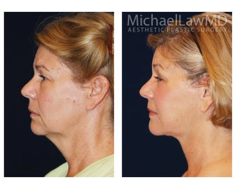 Lower Facial Rejuvenation before 1305117