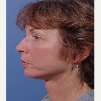 55-64 year old woman treated with Facelift after 3711363