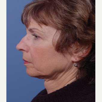 55-64 year old woman treated with Facelift before 3711363