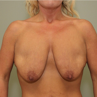 25-34 year old woman treated with Breast Lift with Implants before 3069781