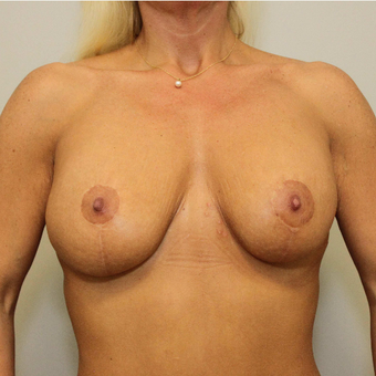 25-34 year old woman treated with Breast Lift with Implants after 3069781