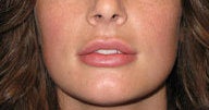 Injectables after 112087