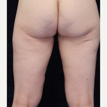 36 year old woman treated with Medial Thigh Lift and Beltlift 1642346